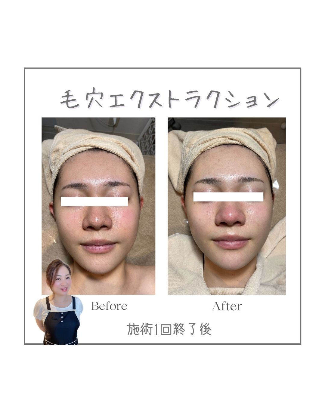 それやると危険！スキンケア3選！/Dangerous Skincare: Top 3 Practices to Avoid!