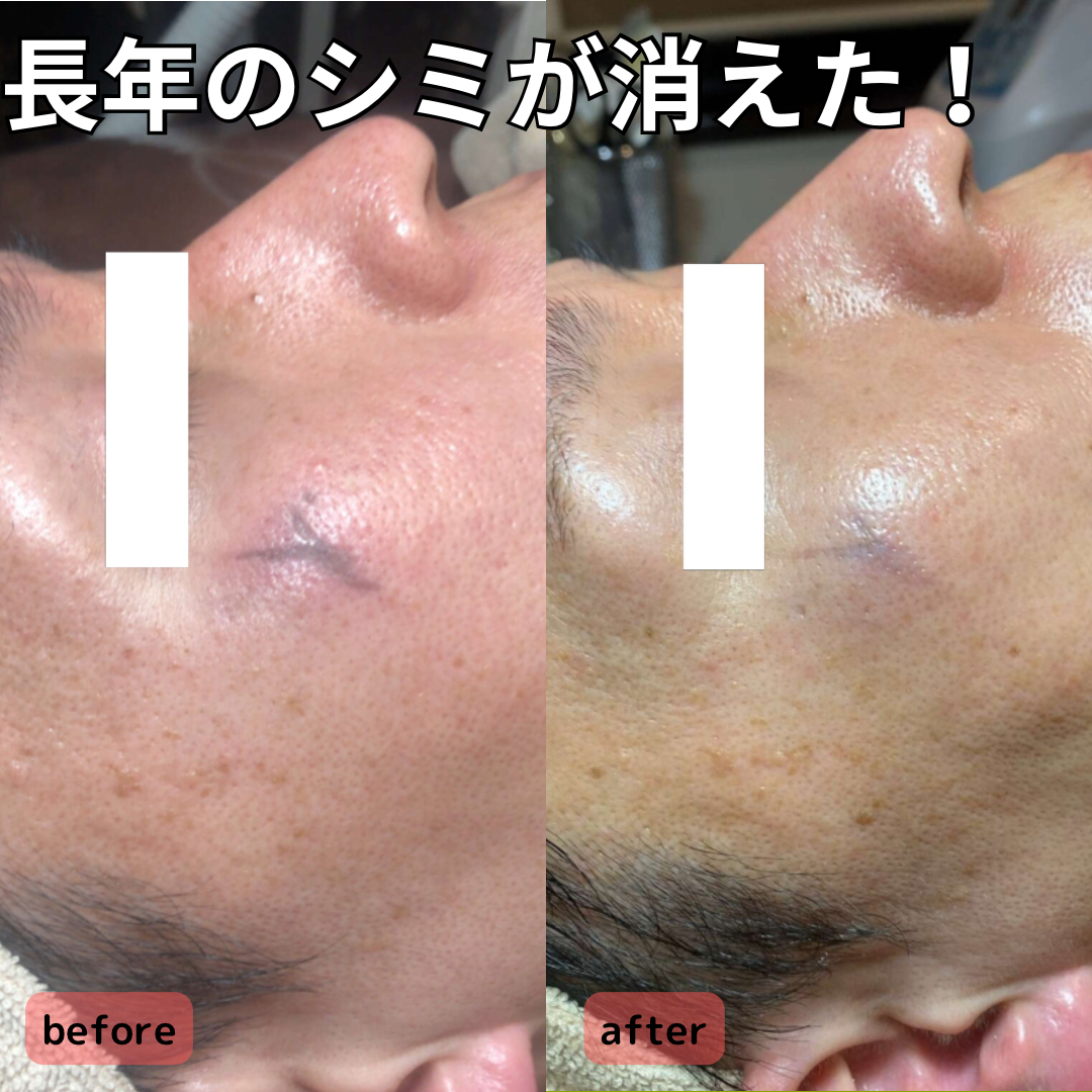 シミ対策今がチャンス！冬にするべき美白ケア！/ Spot Care: Winter Whitening!