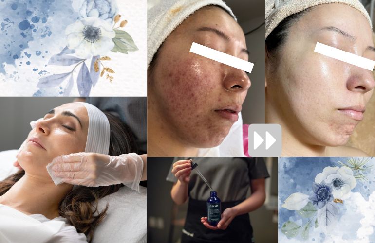 エステに通う頻度はどれくらい？【ニキビケア編】/How often for salon visits? [Acne Care]