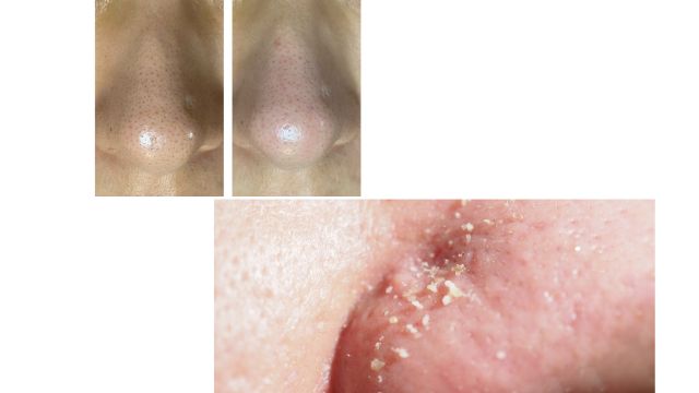 鼻の黒ずみが治らない・・・メラニン毛穴かも？/Persistent Nose Blackheads? Might Be Melanin Pores