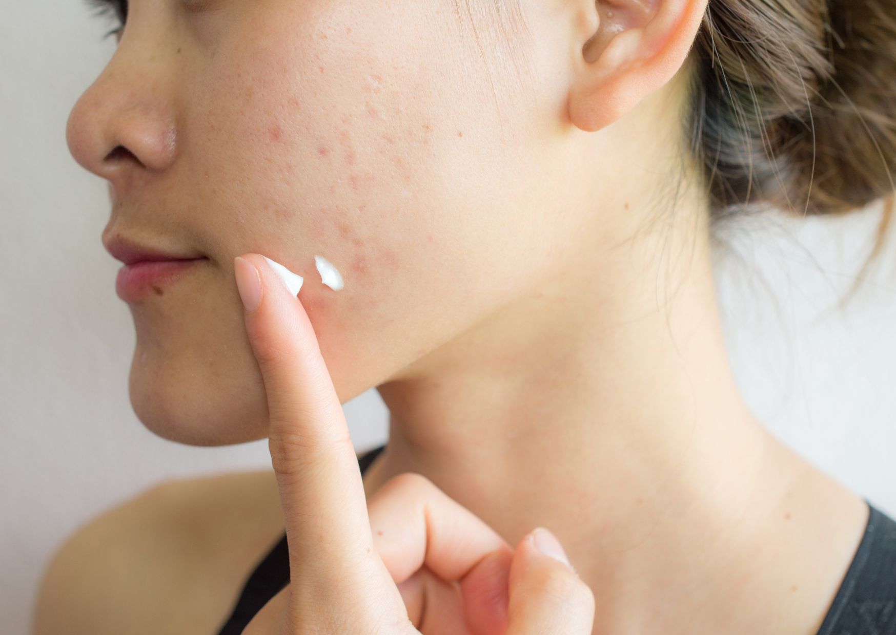 今すぐやって！我慢できないかゆいニキビの対処法/Immediate Relief for Unbearable Itchy Acne